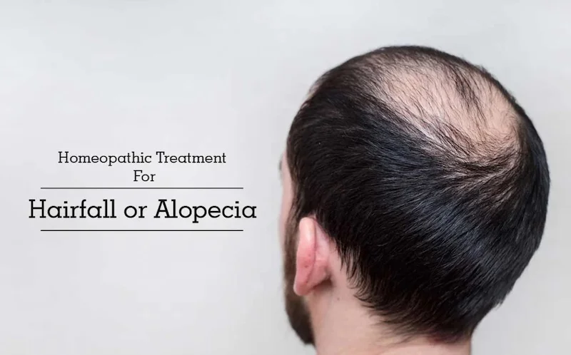 Best Homeopathy Treatment for Hair loss in 2023