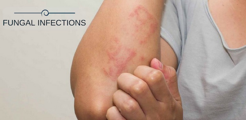 Best Homeopathy treatment for skin fungus infection in 2023